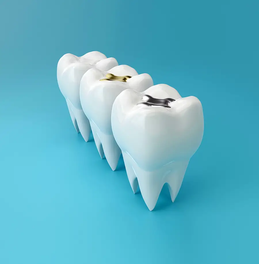 Tooth-Colored Fillings: Cavity Filling with Aesthetic Appeal