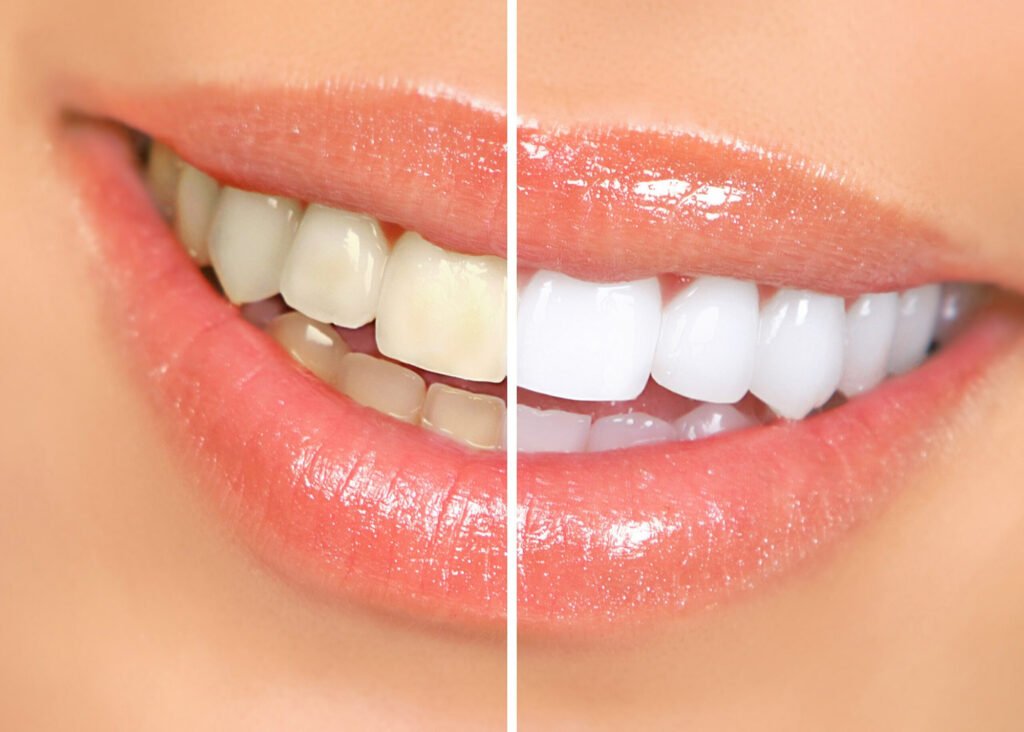 The Ultimate Guide to Teeth Whitening Unveil Your Brightest Smile